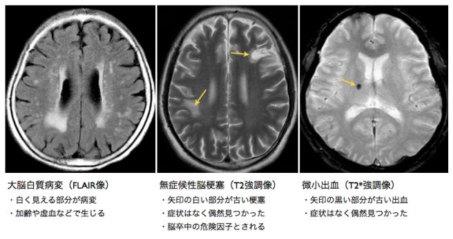脳MRI 1〜3